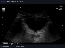 Ultrazvok mehurja - lijakasto oblikovan iztočni del mehurja, urinska inkontinenca 2